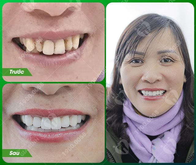Hình ảnh khách hàng trước và sau khi bọc răng sứ Venus tại nha khoa gia đình
