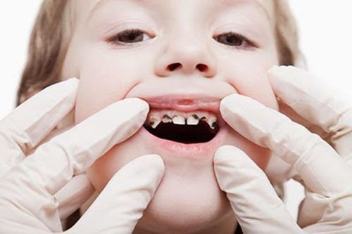 Viêm tủy răng sữa nếu để lâu dài không chữa trị sẽ gây ảnh hưởng không nhỏ cho sức sức răng miệng sau này