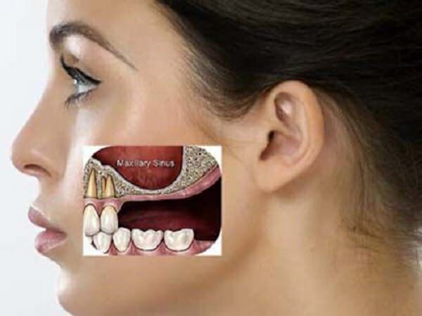 Tiêu xương hàm do mất răng là một trong những nguyên nhân niềng răng gây hóp má