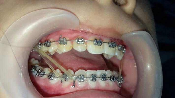 Đeo chun liên hàm khi niềng răng