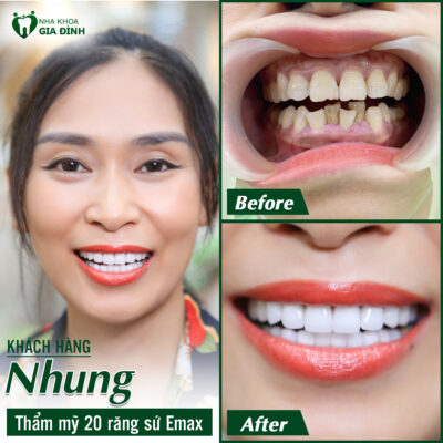 Bọc răng sứ là phương pháp cải thiện tình trạng răng xấu hiệu quả
