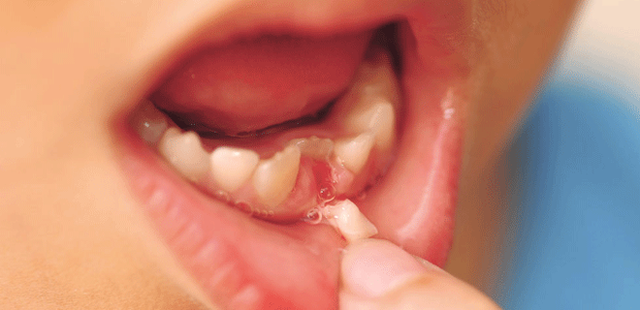 Có nên gây tê khi nhổ răng cho trẻ không là vấn đề mà nhiều bậc phụ huynh lo lắng
