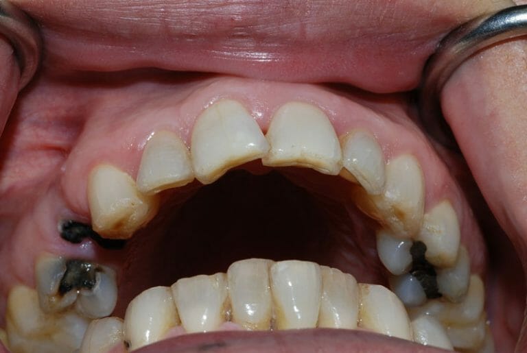 Bị đau răng ban đêm cách điều trị như thế nào? Bác sĩ tư vấn