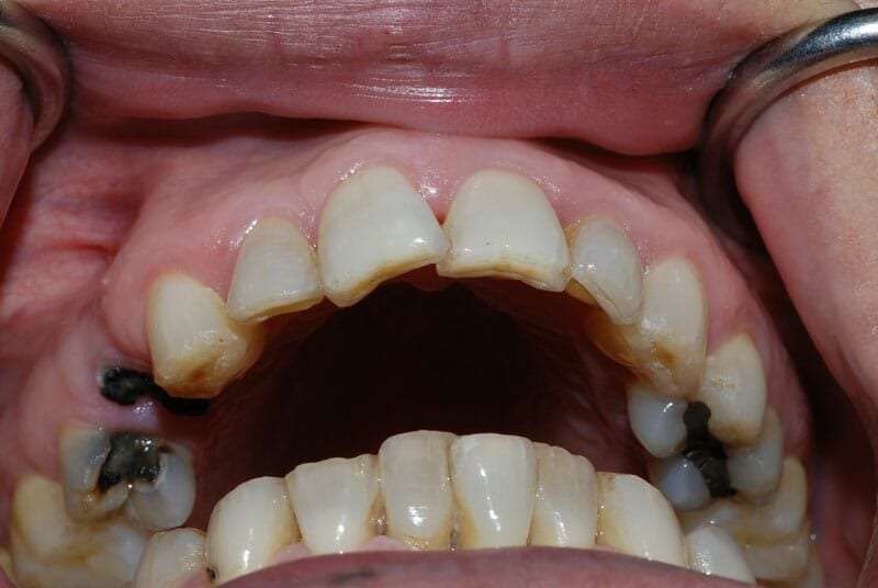 Đau răng so sâu răng