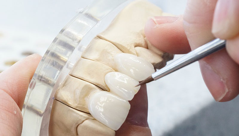 Răng sứu được chế tác tại labo nhập khẩu chính hãng