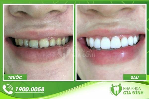 hình ảnh trước và sau khi làm răng sứ