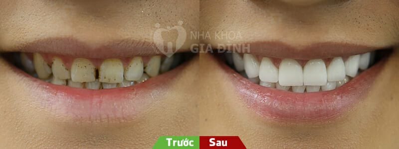 rang-su-veneer-dien-vien-tri-nhan