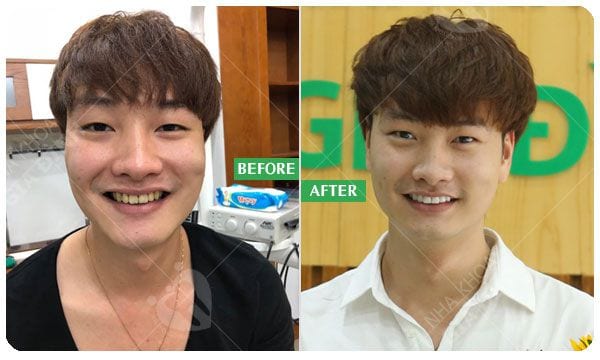 Mặt dán sứ Veneer - Giữ lại tối đa răng thật 7