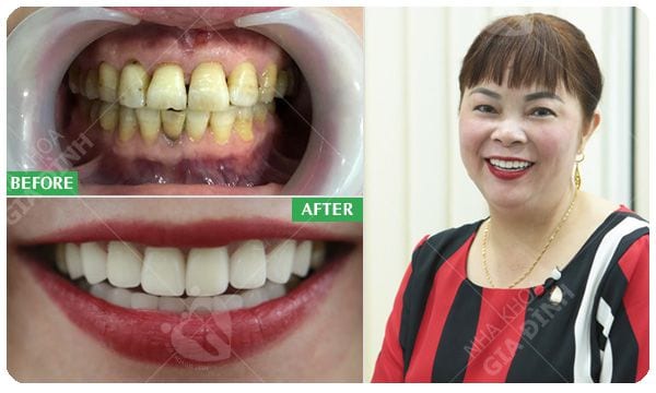 Mặt dán sứ Veneer - Giữ lại tối đa răng thật 4