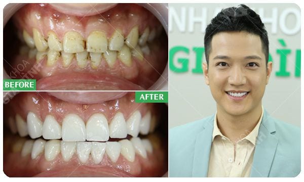 Mặt dán sứ Veneer - Giữ lại tối đa răng thật 5