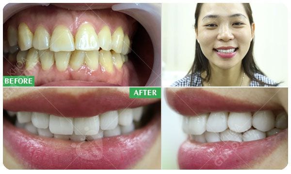 Mặt dán sứ Veneer - Giữ lại tối đa răng thật 6