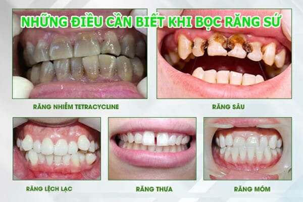 bọc răng sứ chính hãng