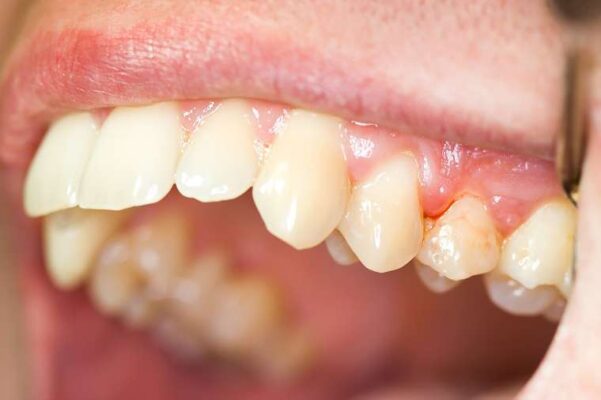 dán sứ sai cách dẫn đến các bệnh về răng miệng