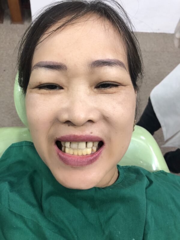 Răng của chị Nga gặp phải tình trạng mòn men răng, răng nhiễm màu kháng sinh nặng. Chân răng bị đen, hàm dưới mọc không đều. Hàm trên xô lệch, thưa nặng