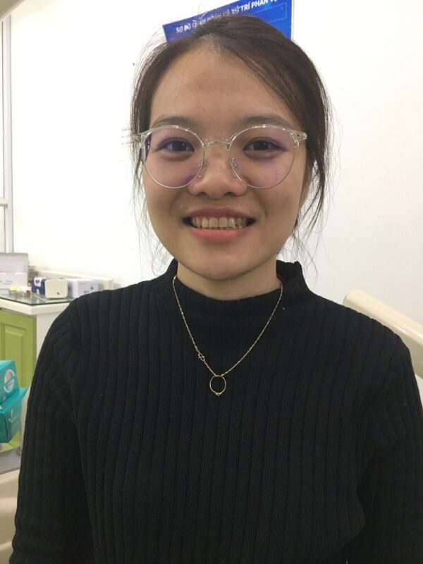 Răng trước khi dán sứ