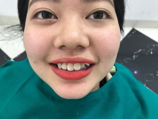 Hàm răng khấp khểnh không đều màu khiến nụ cười mất đi sự tự tin