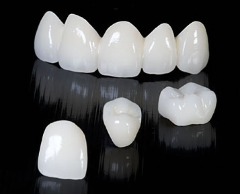  Những ưu điểm vượt trội của răng sứ Emax đã tiếp thêm niềm tin về một hàm răng mới hoàn hảo của Kh Lương Thị Nga.