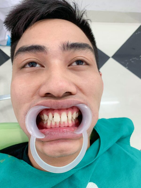 Tình trạng răng trước kia của chàng kỹ sư Lê Văn Bảy