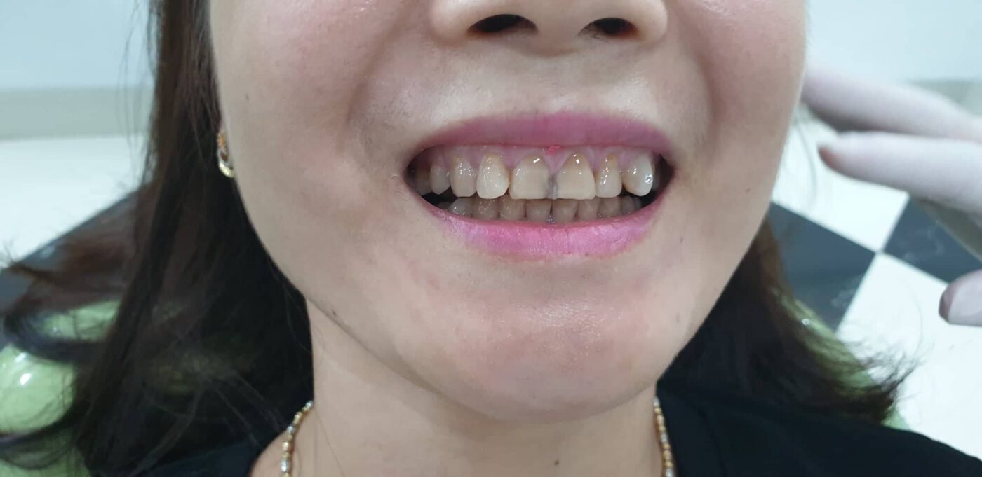 "Chân răng bị đen của khách hàng trước khi tới NKGĐ"