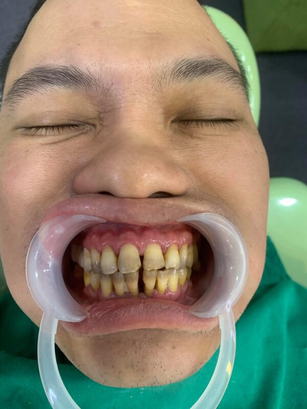 Tình trạng răng nghiêm trọng của anh Hoàng