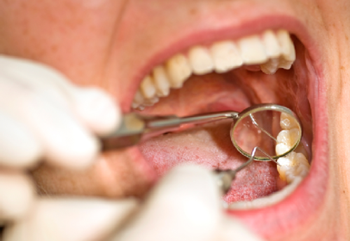Nhiều người sợ hãi với cơn đau lấy tủy răng