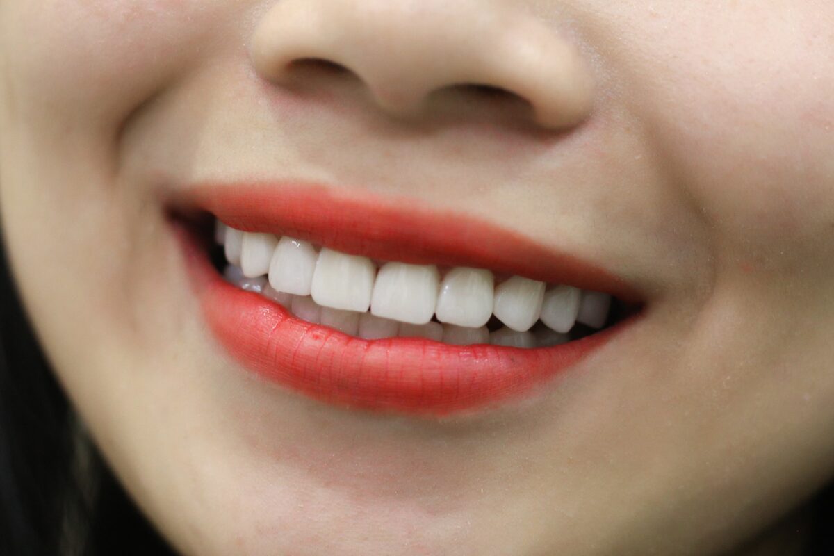  Hàm răng hoàn mỹ được phục hình bởi dán sứ Veneer