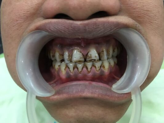 Bạn đã từng cảm thấy tự ti vì hàm răng đen của mình chưa? Những biện pháp trắng răng đắt tiền không giúp cho bạn? Hãy đến với chúng tôi và trải nghiệm điều kỳ diệu - hô biến hàm răng đen thành trắng sáng, rạng rỡ như ngọc trai chỉ trong vòng 30 phút.