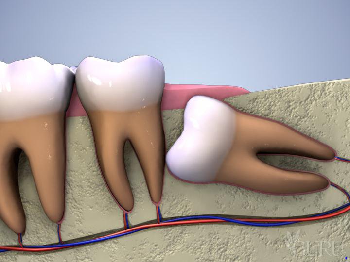 Răng khôn mọc lệch: Chẩn đoán và phương pháp điều trị