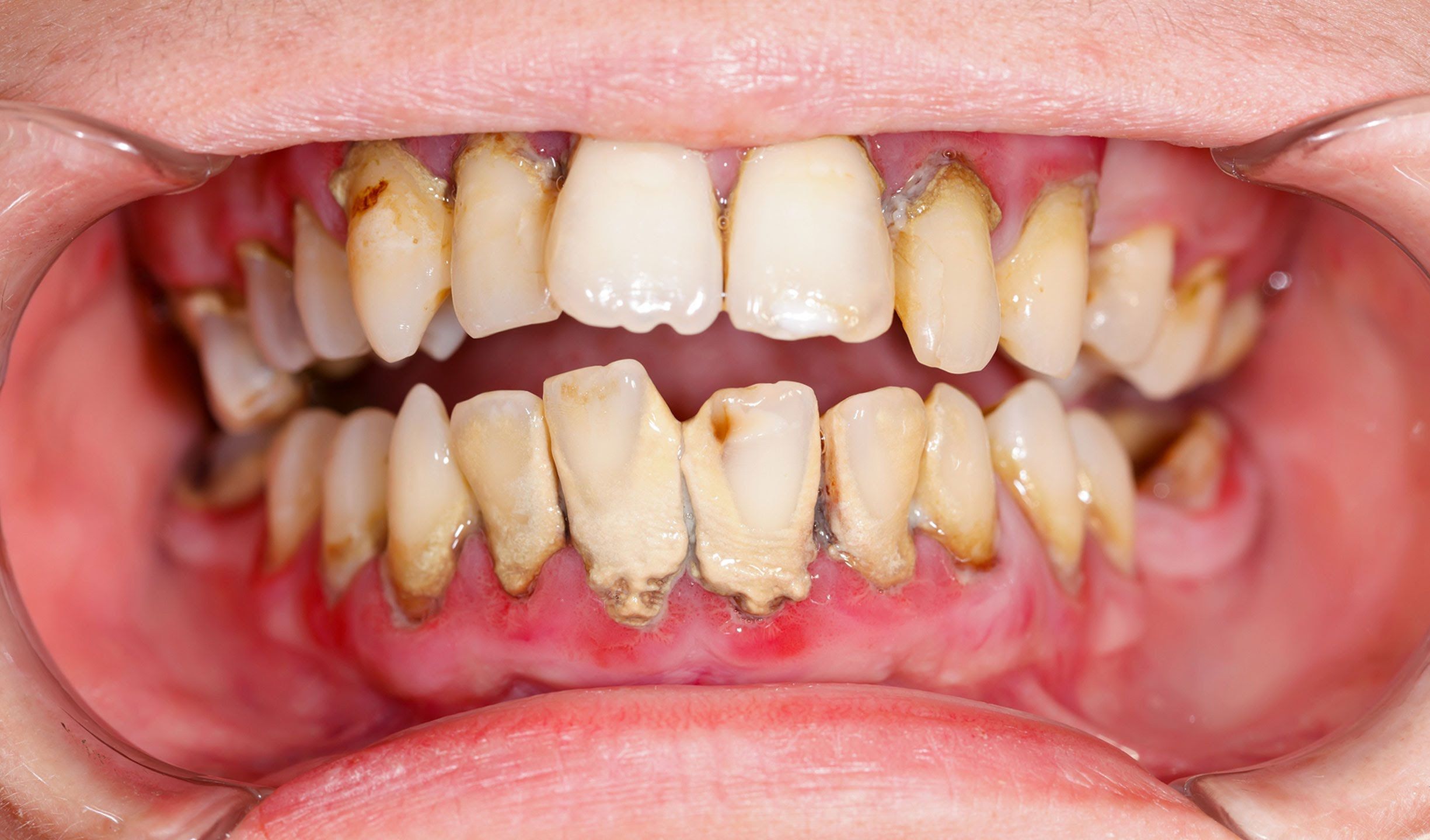Bệnh viêm lợi do cao răng và mức độ nguy hiểm -