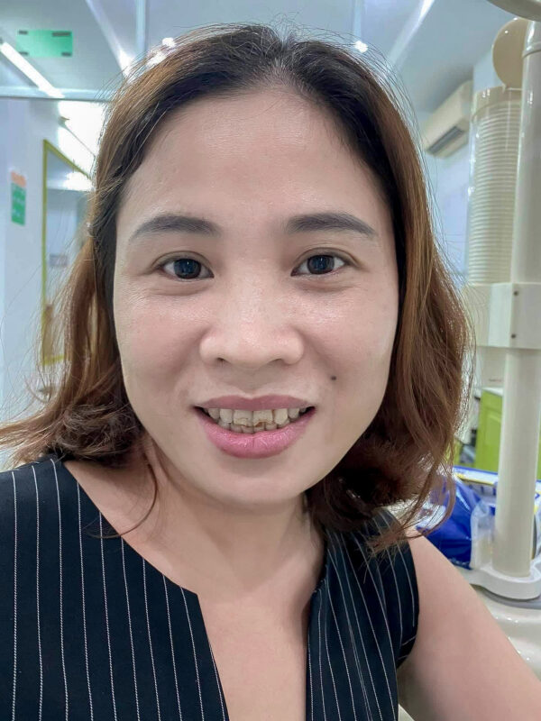  Tình trạng răng của chị Phạm Thị Mỹ Hà