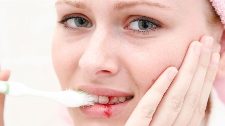 Chảy máu chân răng khi đánh răng
