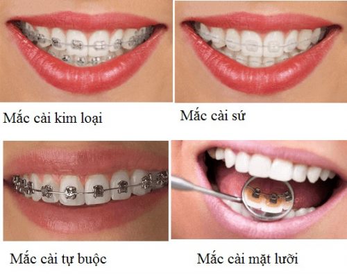 4 loại niềng răng mắc cài