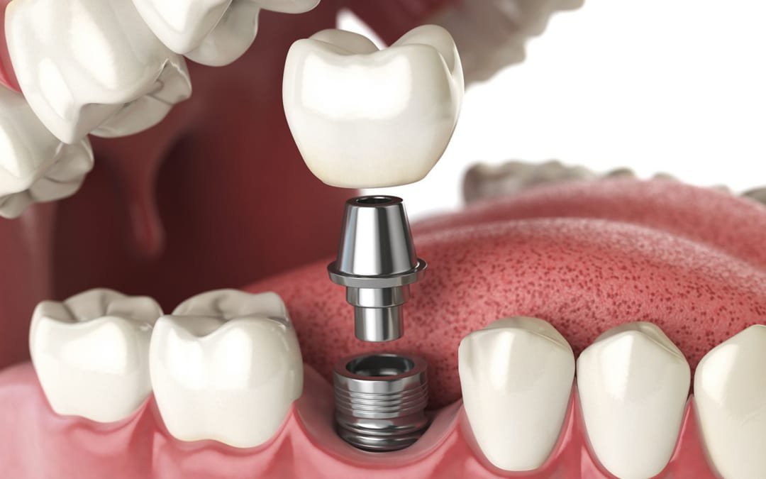 Cấy implant là phương pháp phục hìnhmaatsr răng tối ưu nhất hiện nay