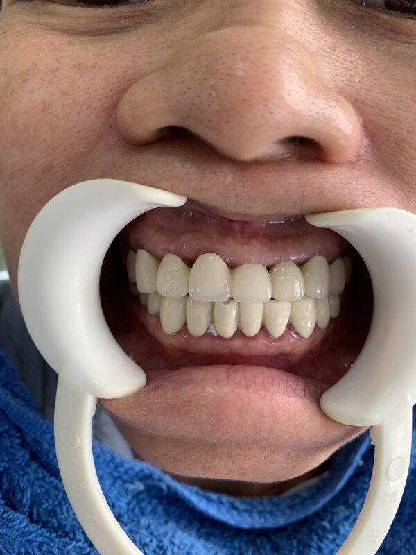  Hình ảnh hàm răng bị bọc sứ hỏng