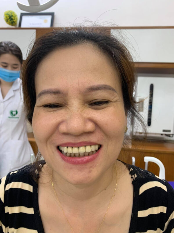 Hàm răng nhiểm màu kháng sinh khiến cô Hà già hơn vài tuổi