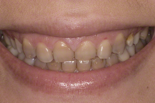 Răng bị nhiễm màu nặng, không thể tẩy trắng được