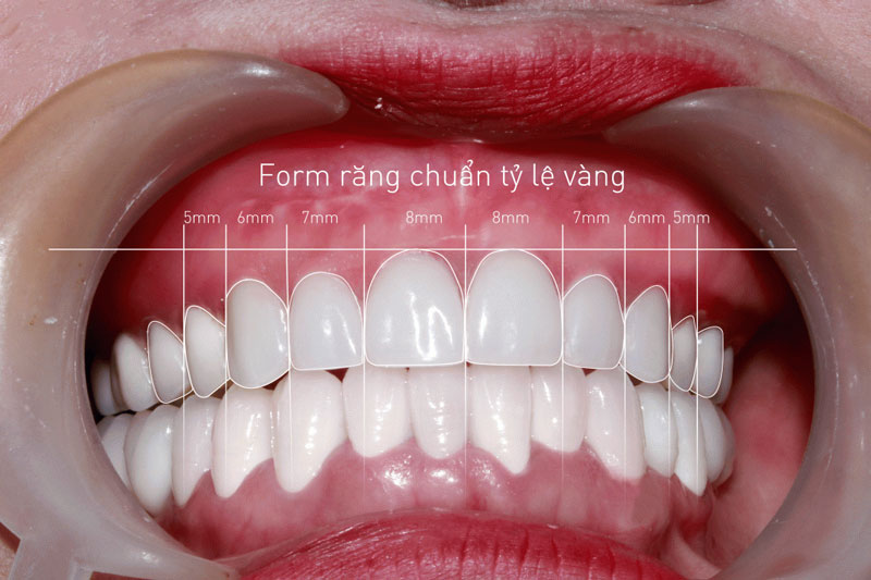 Răng đều, trắng sáng và có sự sắp xếp hài hòa giữa các răng trên cung hàm theo một tỷ lệ phù hợp, đồng thời tỷ lệ chiều rộng của răng bằng 75 – 85% chiều dài, tùy theo hình dáng khuôn mặt.