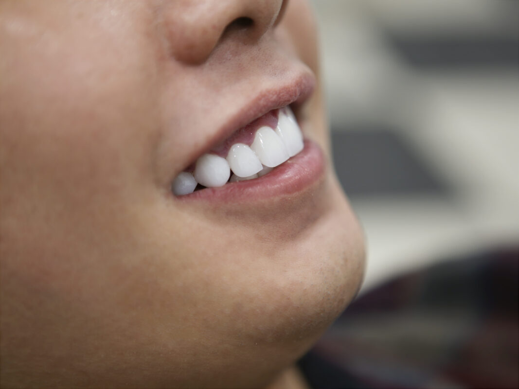 Hàm răng đều, trắng sáng nổi bật sau khi thẩm mỹ 18 răng sứ HT Smile