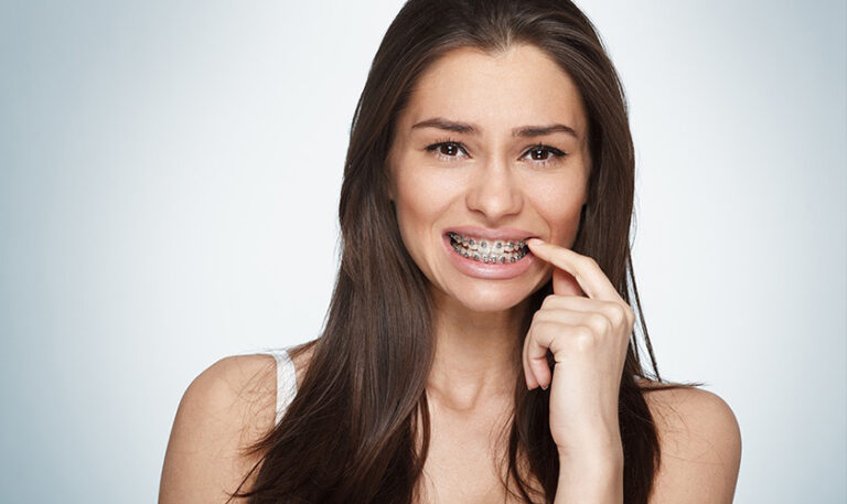 Có cần nhổ răng khôn khi niềng răng không?