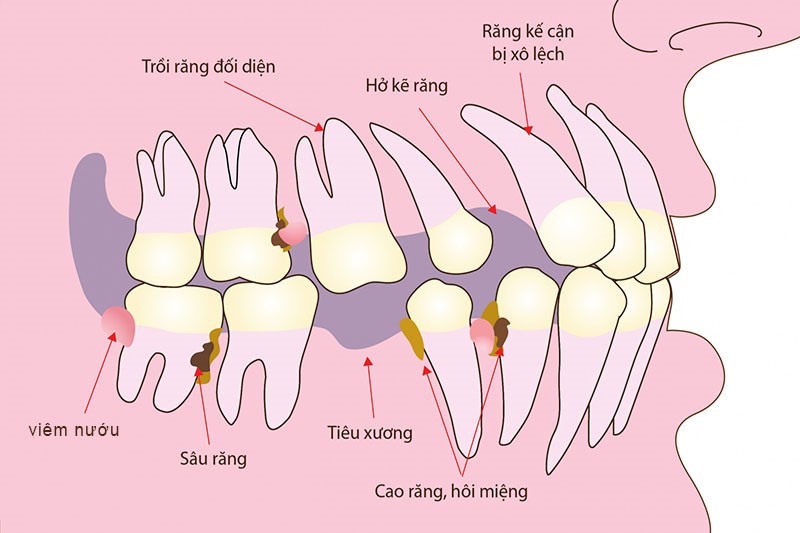 Mất răng lâu sẽ ảnh hưởng tới các răng bên cạnh