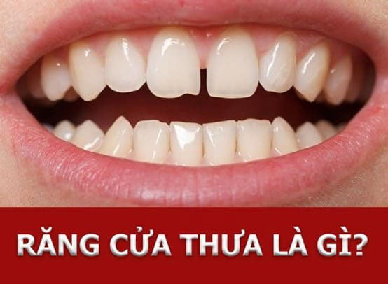 7. Trám Răng Composite: Giải Pháp Nhanh Gọn