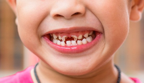Bệnh sâu răng hay gặp ở trẻ