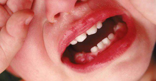 Viêm nướu khi mọc răng làm trẻ khó chịu, dễ khóc quấy