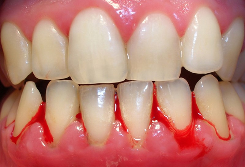  Viêm nướu có thể gây ra hiện tượng mất răng hàng loạt