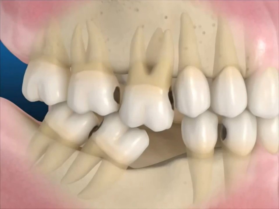 Mất 1 răng dẫn đến các răng khác cũng bị ảnh hưởng