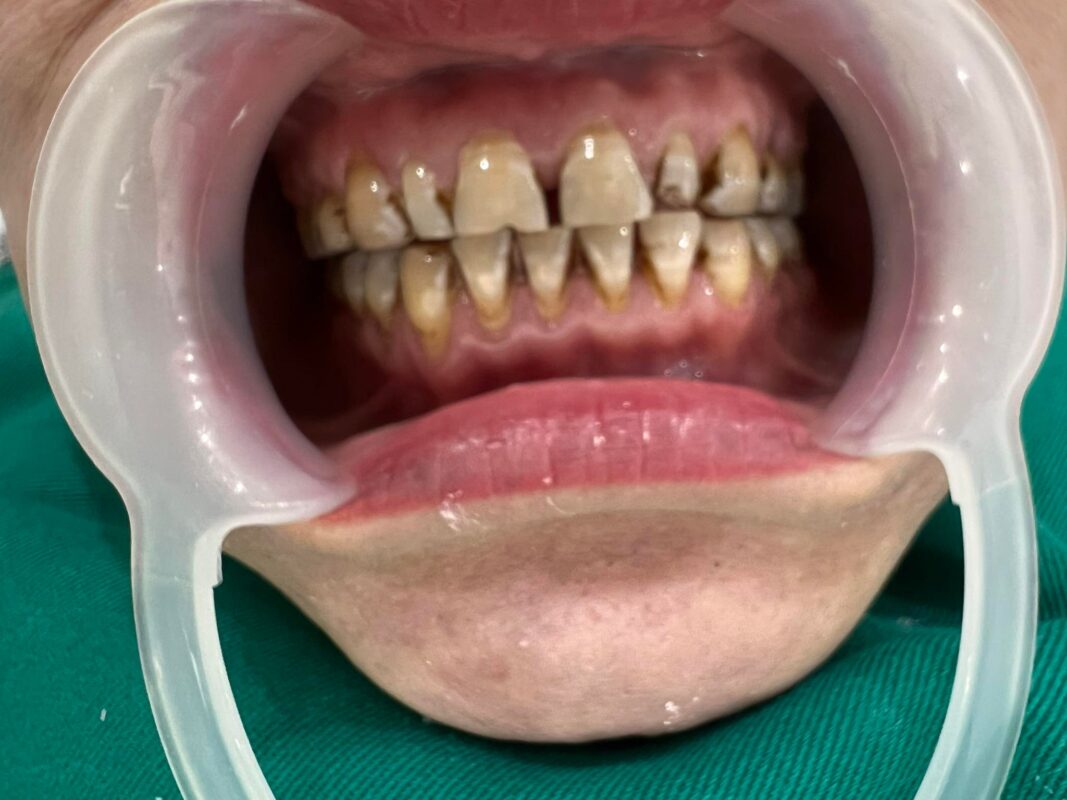 Hình ảnh hàm răng trước đây của chị Chuyên