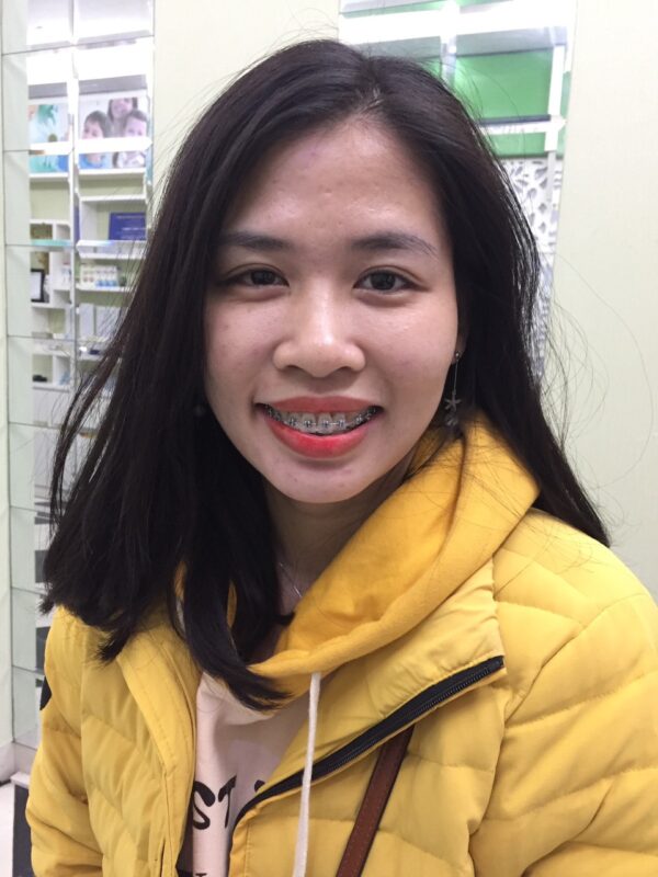 Nhờ sự kiên trì đeo niềng, chị Nhung đã có được hàm răng ưng ý