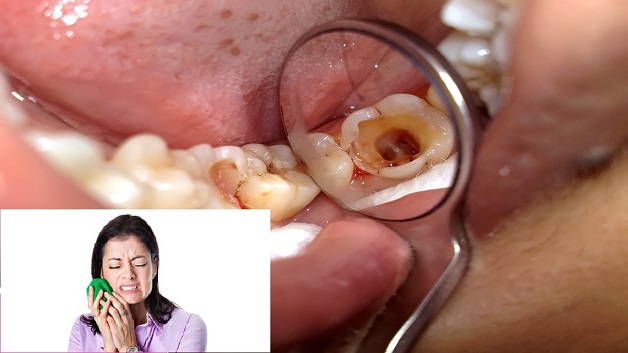 Đau tủy răng có thể dùng cốt là chuối để giảm đau