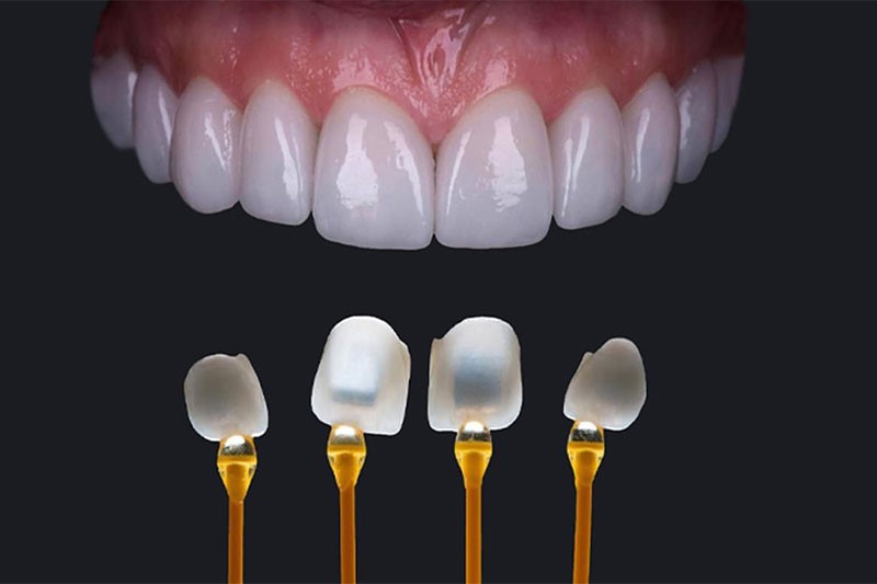 Miểng dán mỏng, trong bóng tạo hiệu ứng ánh sáng như răng thật