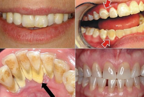 Vệ sinh răng không sạch tạo thành cao răng gây sưng nướu